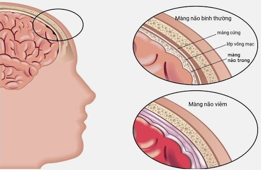 Bệnh thủy đậu có thể gây biến chứng viêm màng não