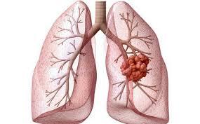   Viêm phế quản có nguy cơ tiến triển thành ung thư phổi