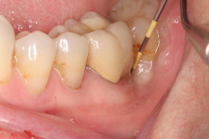   Tình trạng viêm quanh cuống răng