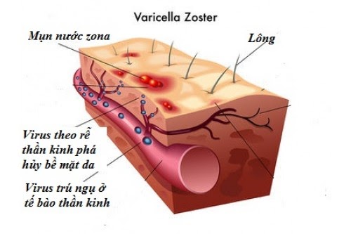 Thủ phạm gây ra bệnh zona là siêu vi khuẩn varicella zoster