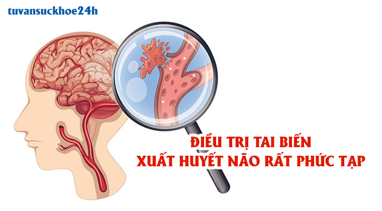 Điều trị tai biến xuất huyết não vô cùng phức tạp