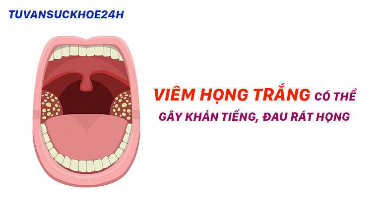 Viêm họng trắng có thể gây khản tiếng, đau rát họng