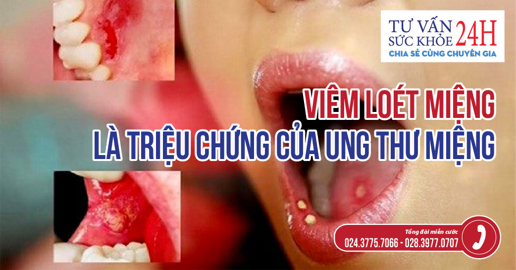 Viêm loét miệng là triệu chứng của ung thư miệng