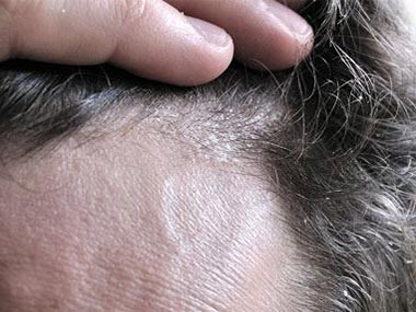   Bệnh á sừng da đầu là tình trạng như thế nào?